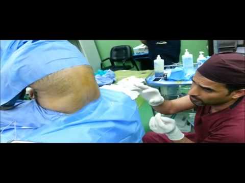 Steroid injection for back pain video