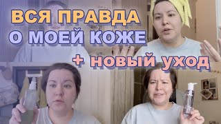 Я ВЕРНУЛАСЬ! Вся правда о моей коже, уходе + эксперимент 🥰