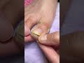 Ingrown Toenail Correction Foot Care Nail Treatment Shorts