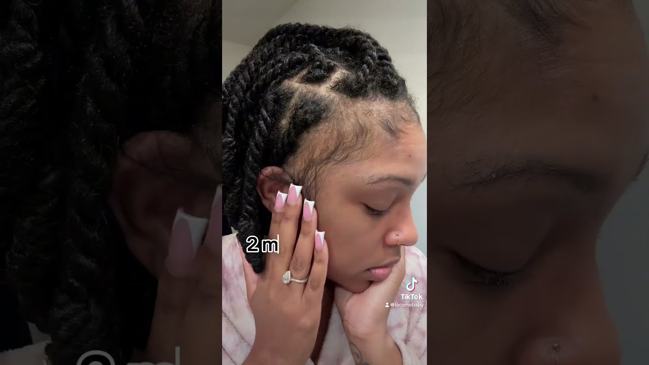 1 Month Vs 2 Months Using Minoxidil On My Edges The Results Are In Alopecia Hair