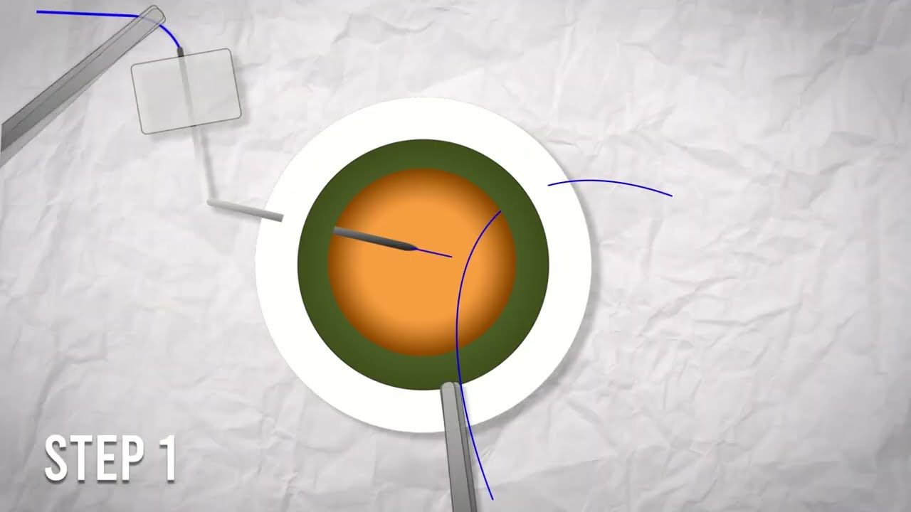 Reverse 4 Flanged Technique - Intrascleral IOL Fixation