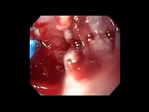 Complex, Benign Refractory Esophageal Stricture