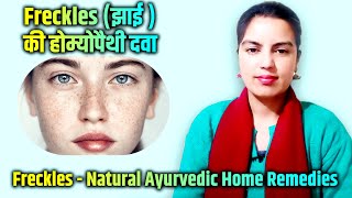 Homeopathic Medicine for freckles | Freckles (झाई )की होम्योपैथी दवा | Home Remedies for Freckles