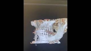 Титановая челюсть заменила разрушенные кости