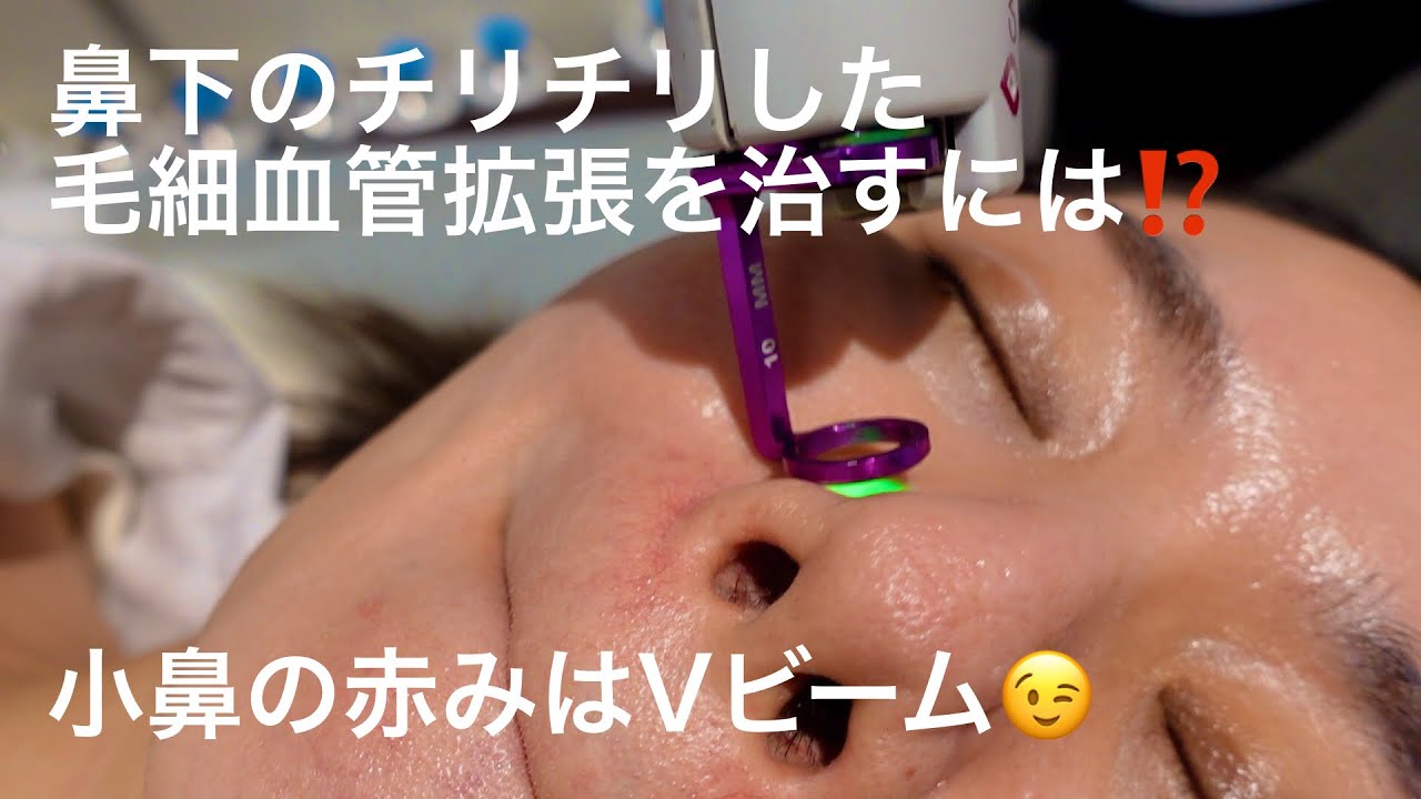 鼻下の毛細血管拡張 小鼻の赤みはこうやって治療する Vビーム2によるレーザー治療 皮膚科専門医が解説 Youtube