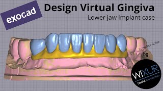 How To Design Gingiva (Crowns on Implants)