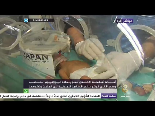 نافذة تفاعلية .. تفاقم أزمة تشوه الأجنة في قطاع غزة والإصابات تتجاوز 100 حالة