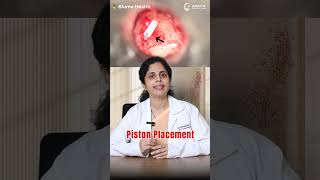 లేజర్‌తో వినికిడి లోపానికి శాశ్వత పరిష్కారం.