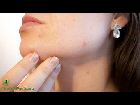 וִידֵאוֹ: מאיפה בא acne vulgaris?