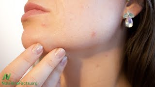 Natural Treatment for Acne and Fungal Infections