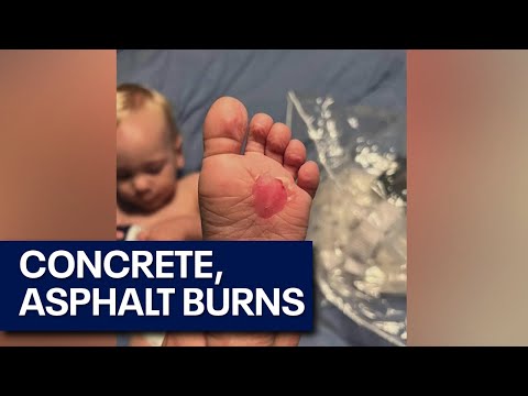 Toddler suffers 2nd-degree burns from hot ground