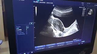 Uterus Ultrasound Tips