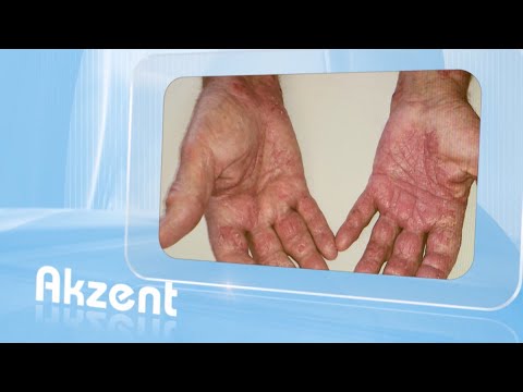 Video: Psoriasis-Arthritis: Hände, Füße Und Mehr