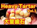 当院史上最強に硬い‼️大量歯石除去🦷硬すぎて1回で取りきれません😭Removed a lot of hard tartar