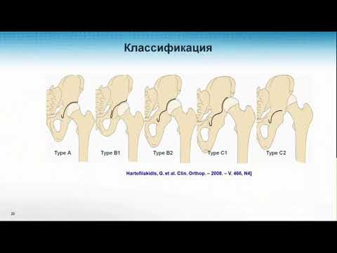 эндопротезированния тазобедренного сустава.