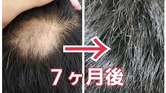 円形脱毛症 Youtube 円形脱毛症 Youtube