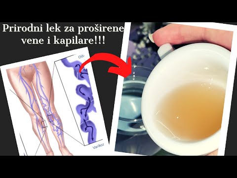 Krčne žile izginejo v 3 tednih! | Naravno zdravilo za krčne žile!