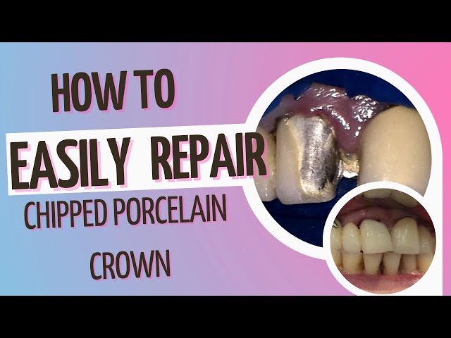 How to repair Porcelain or Ceramic crowns using Waldent Ceramic