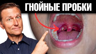 Как Избавиться От Гнойных Пробок В Горле Навсегда? 🧐