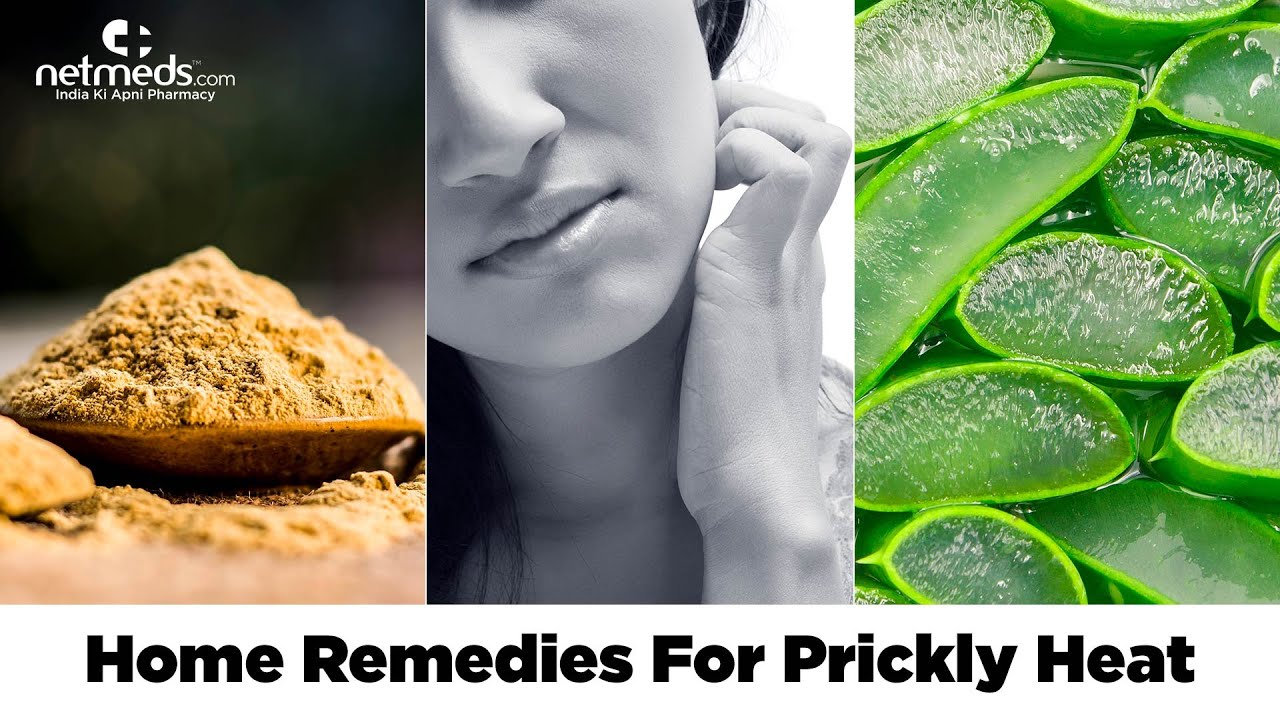 Prickly heat (heat rash)- Causes, home remedies and preventions