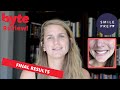 Final results w byte atnight for crooked teeth  honest smiles review  byte at night reviews