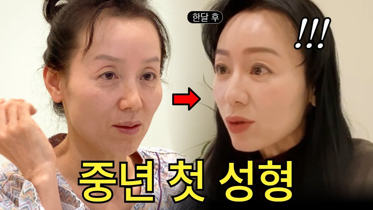 [Вондерфул Гоо сайхны эмнэлэг] Бүрэн нүүрний өөх шилжүүлэн суулгах, доод зовхи, нүдний дээд хэсэгт өөх шилжүүлэн суулгах туршлага | Дунд насны гоо сайхны мэс заслын влог