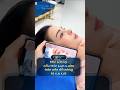 Mũi Bị Co Rút, Ngắn Hếch: Sửa Lại Có Đẹp Được Không? 😱