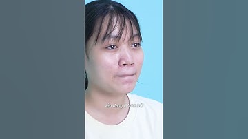 Tự ti vì mũi tẹt và kết quả sau 14 ngày