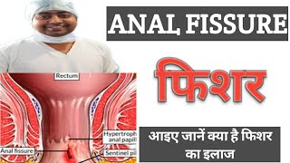 फिशर ।। Anal Fissure ।। हिन्दी में ।। जानें क्या है फिशर ? ।। डॉ सूर्य प्रकाश