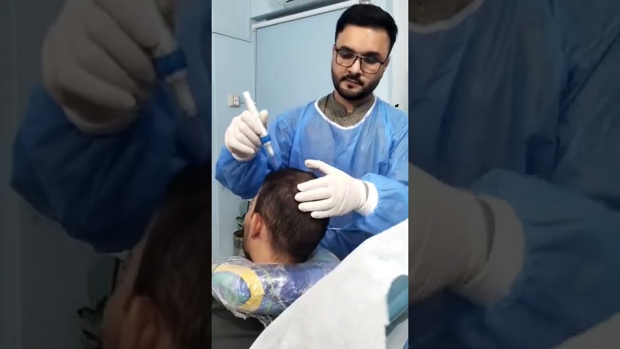 PRP Hair Treatment with Microneedling 