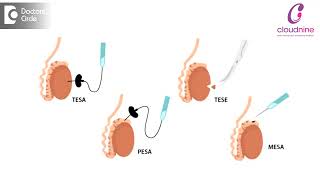 Techniques for Surgical Sperm Retrieval I Dr. Sathya Balasubramanyam I Cloudnine Hospital
