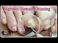 👣 Online Ingrown Toenail Cleaning Lesson Home Pedicure Tutorial👣 ⭐