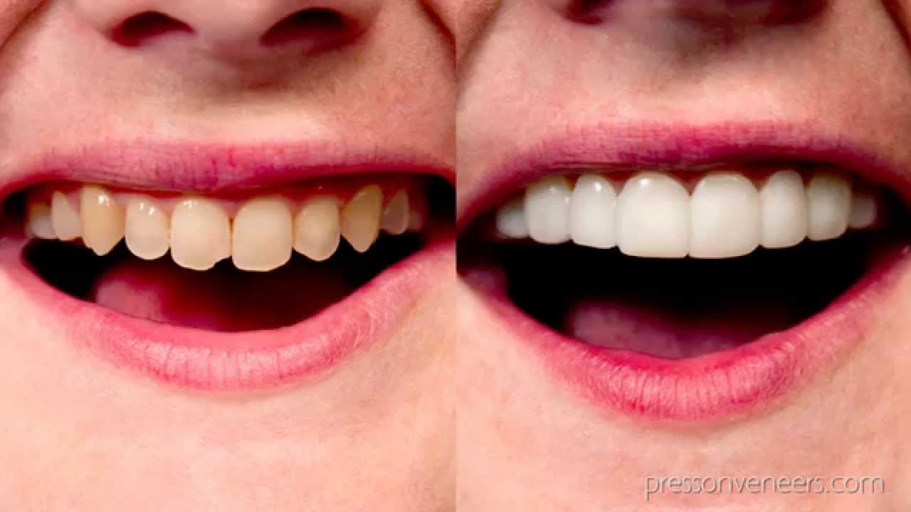 Press On Veneers The Secret Dentists Can't Tell You! YouTube