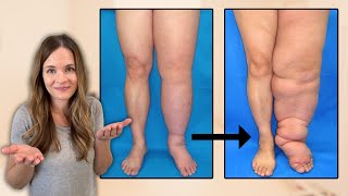 What is Lymphedema?