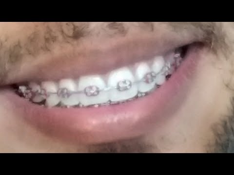 Vídeo: Qual A Cor Do Batom Que Deixa Os Dentes Mais Brancos: As Regras Para Escolher Tons Que Escondem O Amarelo