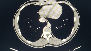 Stomach Duplication cysts
