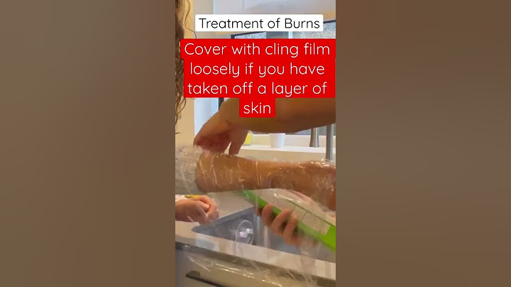 Dealing with burns - first aid treatment | First aid #burns #firstaidtreatment