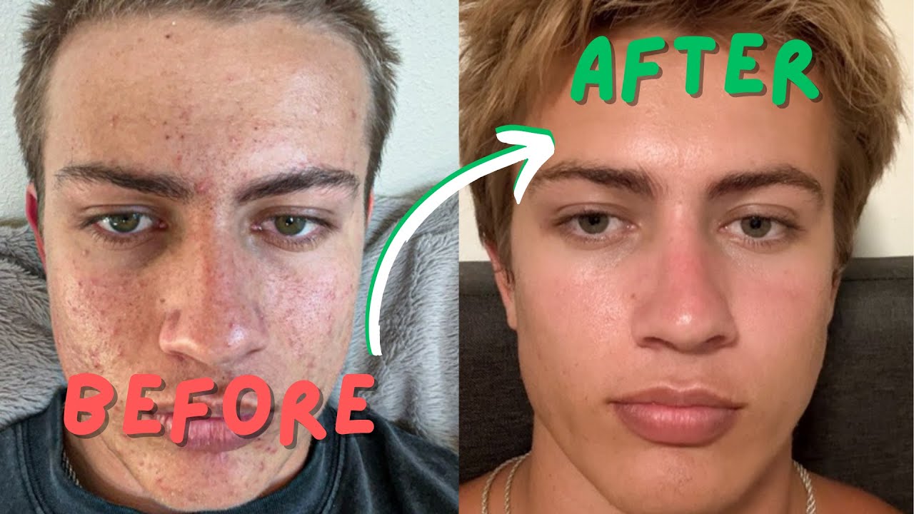 I cleared my skin in 90 days WITHOUT products (Here's how) - YouTube