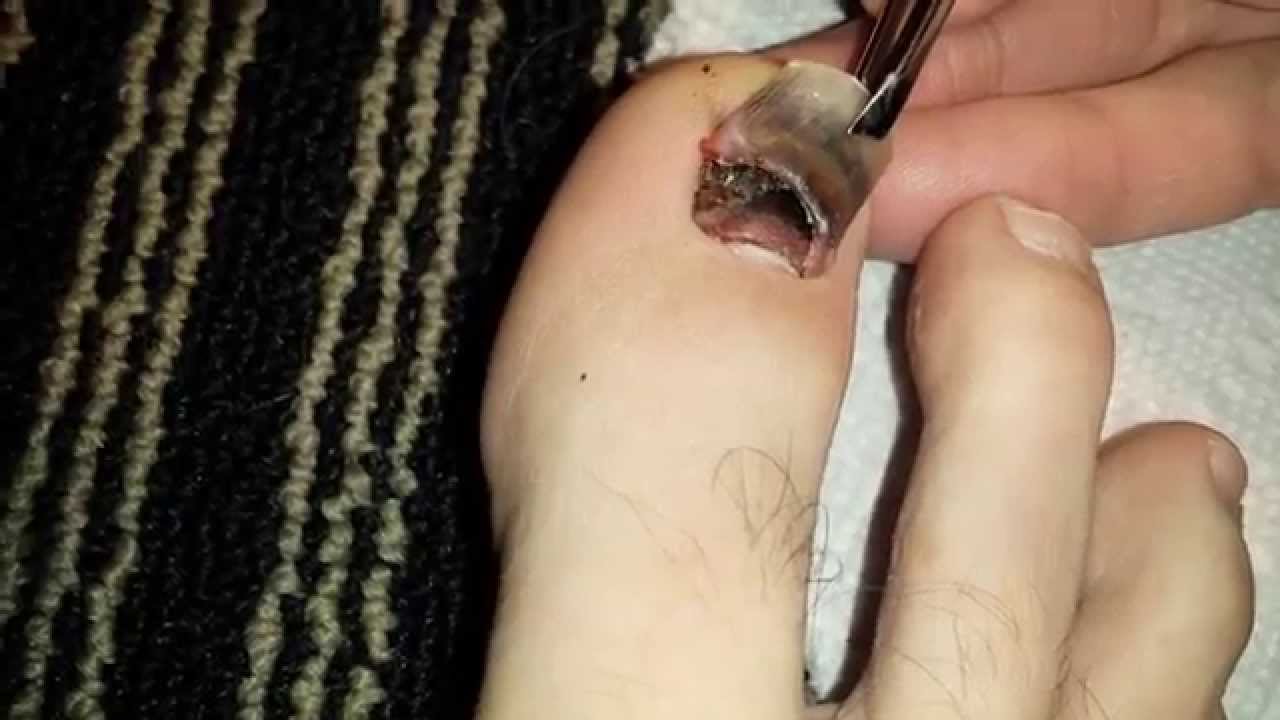 How do you get rid of black toenails?