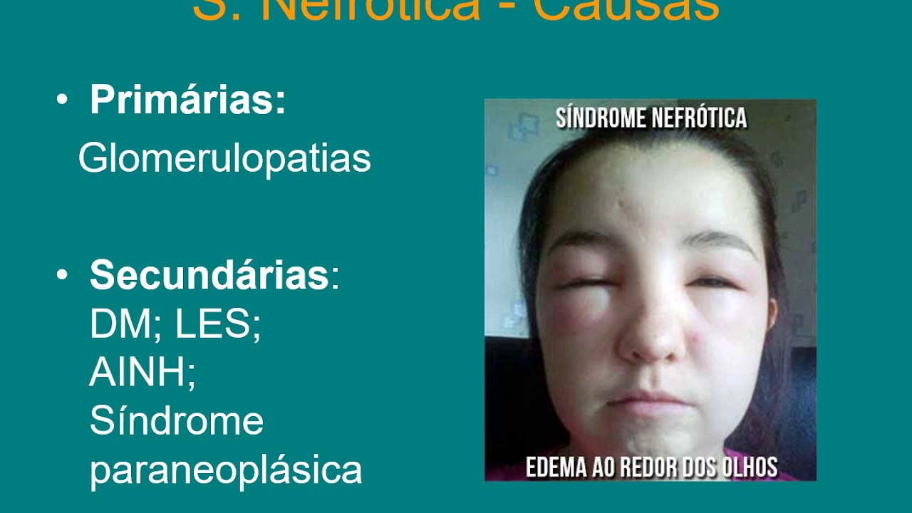 Sindrome Nefrotica Renal Síndrome Nefrótico: MedlinePlus