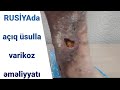 varikoz damar xesteliyinin deqiq müayinesi emeliyyata gösteriş ve eks gösteriş VENA DOPLER MÜAYİNE