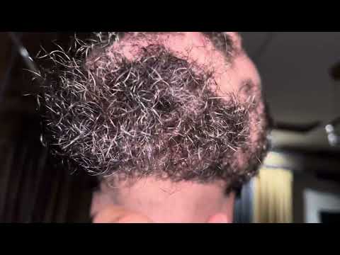 ASMR HAIR BEARD LINE PIMPLE REMOVED SATISFYING VEDIO ODDLY | INGROWN 10 INGROWN