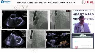 A. Mitsis | PFO Closure: To close or not to close?