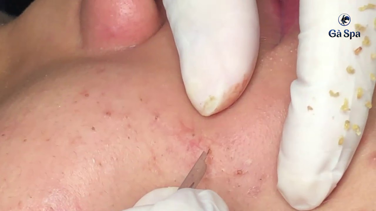gà spa whiteheads