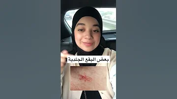4 علامات تدل على مرض في الكبد 