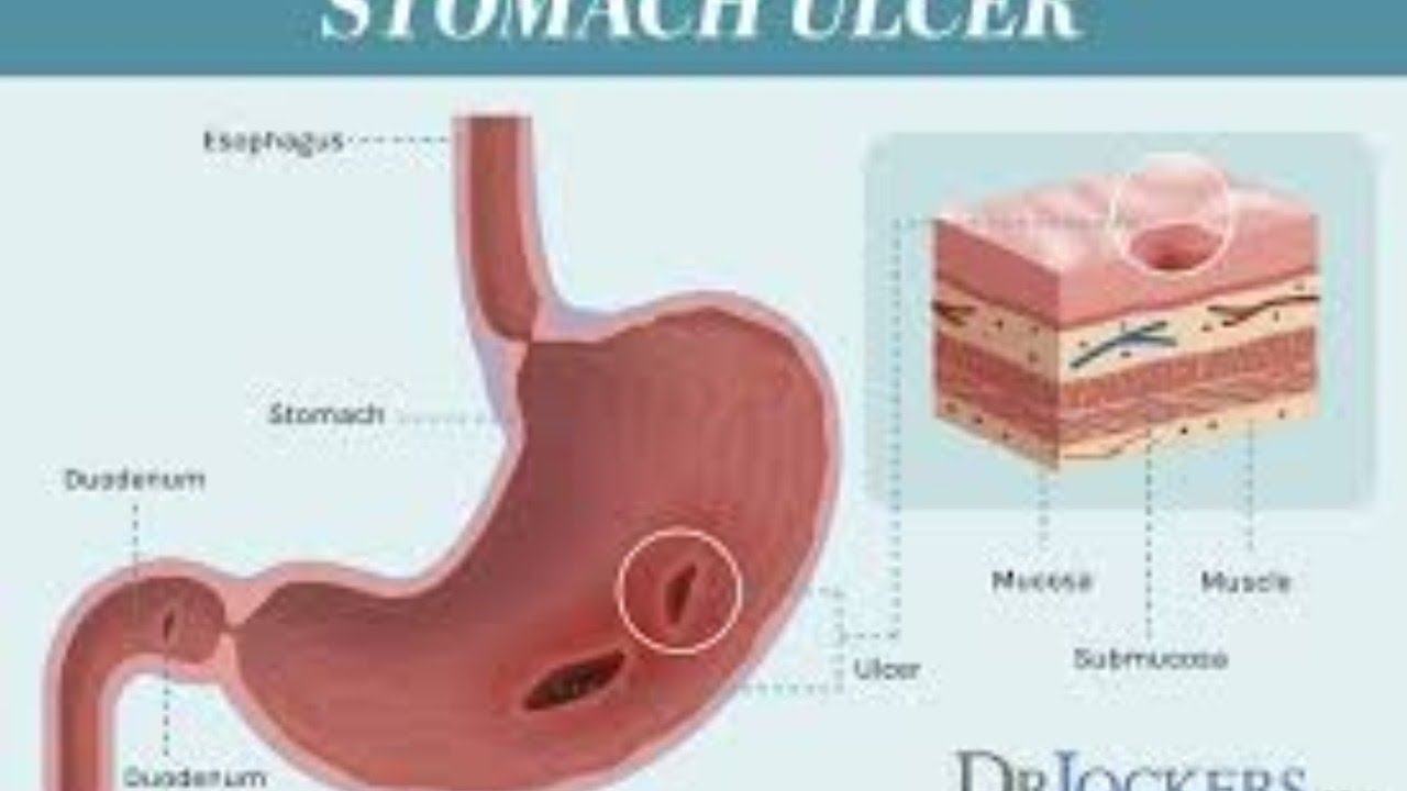 DIYAcupressure/Acupuncture point may relief stomach ulcer/gastric