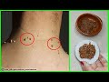 With just 3 ingredients, get rid of skin tags in one night | How to remove skin tags at home