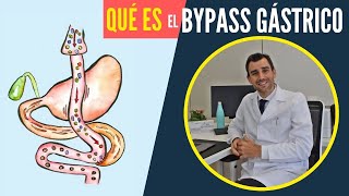What Is Gastric Bypass  Dr lvaro Bueno Delgado