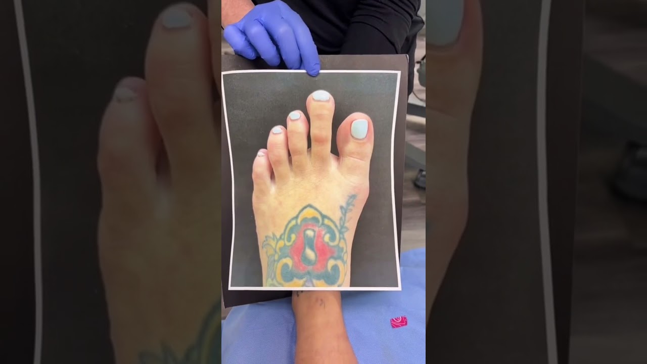 FOOT REDUCTION SURGERY: BEFORE & AFTER (Yes, We Can Make Feet Smaller) ❤️