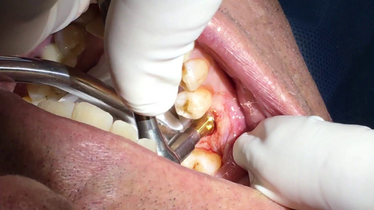 Dental Implant Healing Cap Placement Part 6 Dr John Paul Gallardo Miami Fl Youtube 